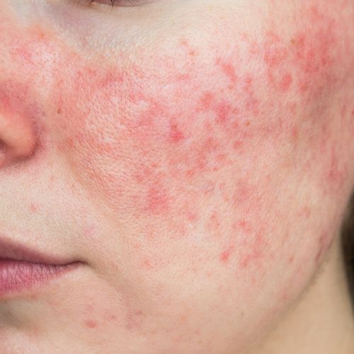 Winter Skin Challenges | deniseferrandinicosmetics.com