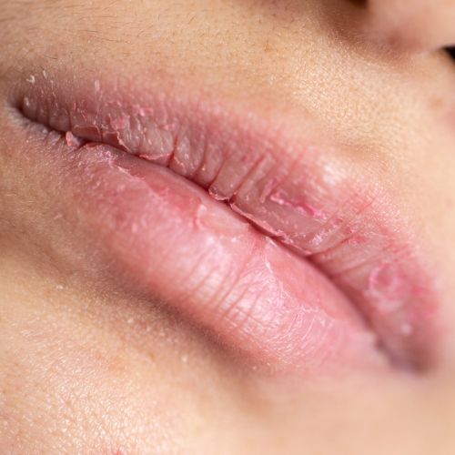 dry lips | deniseferrandinicosmetics.com